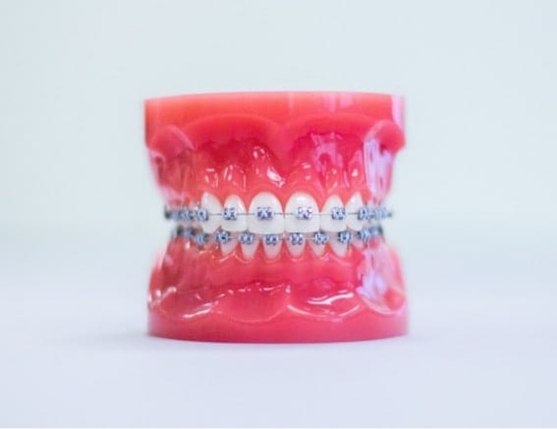 Modern Braces Mold